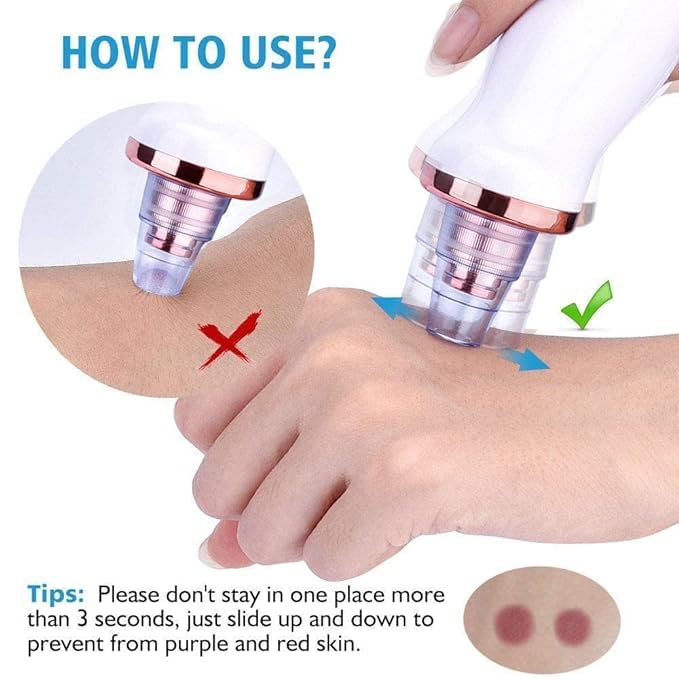 PorePerfect® - 6 in 1 Multifunctional Blackhead Remover Tool