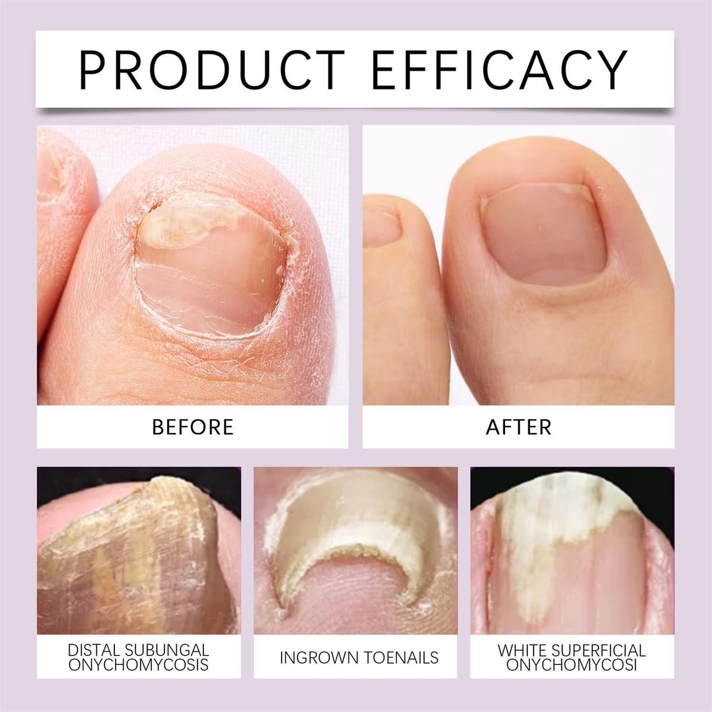 (BUY 1 GET 1 FREE) FungiFree® Bee Venom Nail Treatment Solution Serum
