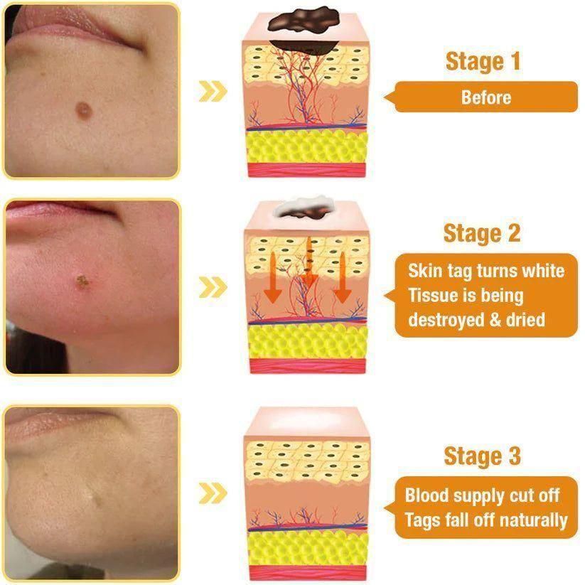 Bee Venom Wart Care Spray (Pack of 2)