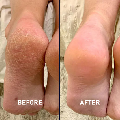 (BUY 1 GET 1 FREE) TeaTree® Oil Foot Cream - Deep Moisturizing & Soothing Foot Care