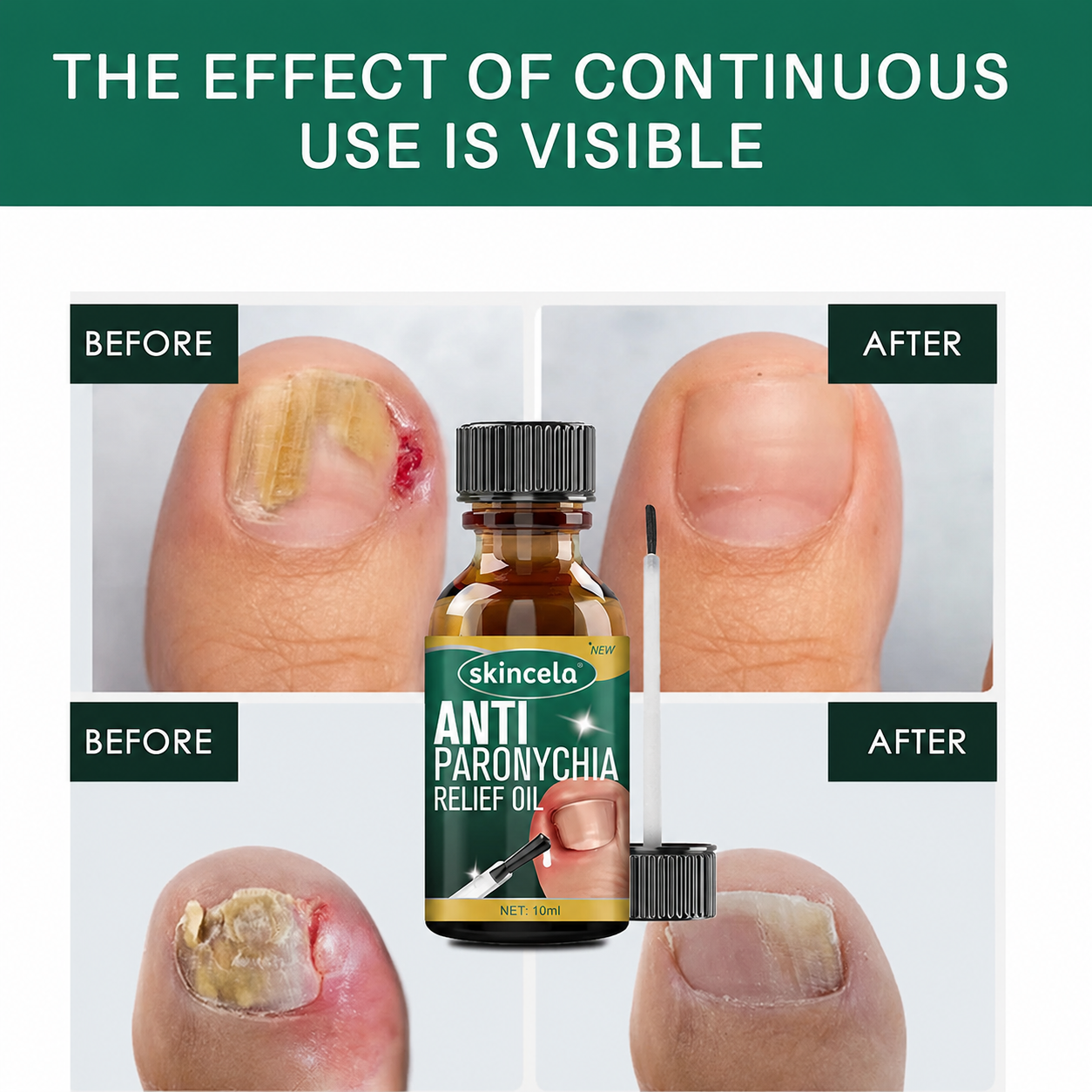 (BUY 1 GET 1 FREE) Skincela® - Magic Nail Anti-Paronychia Relief Oil