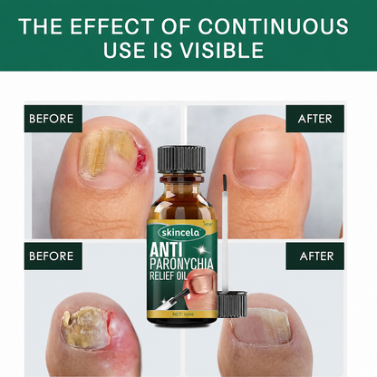 (BUY 1 GET 1 FREE) Skincela® - Magic Nail Anti-Paronychia Relief Oil