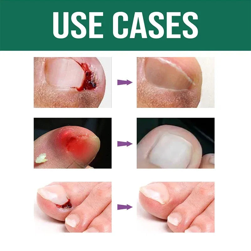 (BUY 1 GET 1 FREE) Skincela® - Magic Nail Anti-Paronychia Relief Oil
