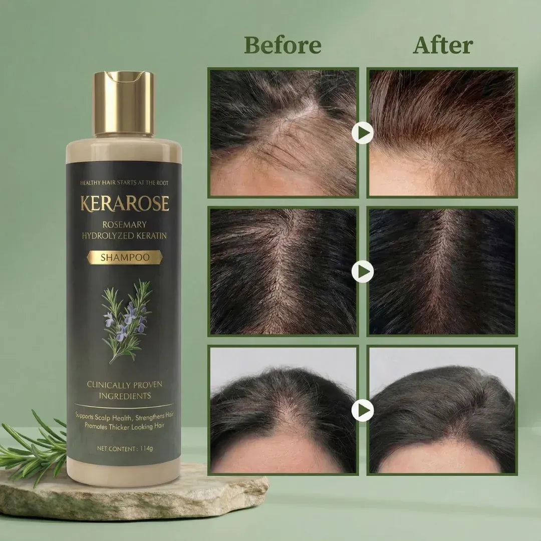 (BUY 1 GET 1 FREE) Kerarose® - Magic Rosemary Hair Growth Shampoo