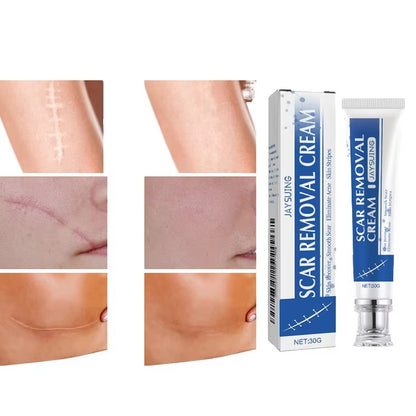 (BUY 1 GET 1 FREE) ScarAway® - Scar Removal Cream 100g