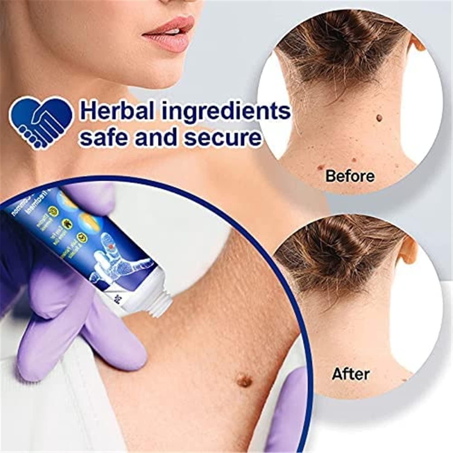 Wart Care Cream (Pack of 2)