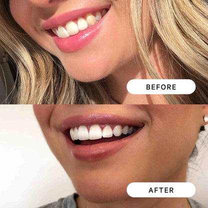 PearlaPen™️ - Teeth Whitening Gel Pen